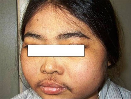 Bệnh nhân bị hội chứng Cushing và mọc râu do dùng corticoid.
