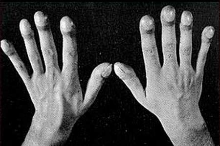Bệnh phổi kẽ - Mối nguy ngày rét - 2 Móng tay có đường cong trong bệnh phổi kẽ.