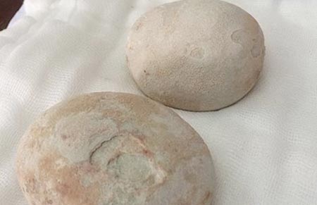 Lấy 2 viên sỏi khổng lồ trong bàng quang