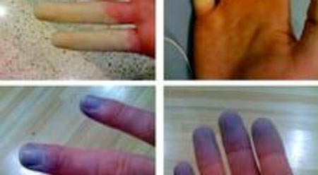 Cứ lạnh là... đau - Bệnh gì? - 1 Hiện tượng Raynaud: các đầu ngón tái lạnh từng mảng, tím,
lan nhanh ở cả hai bàn tay.