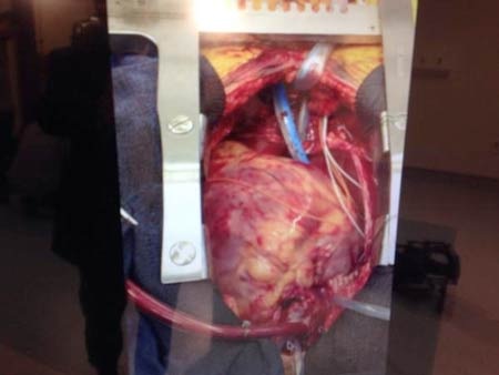 Những bước đột phá trong y học năm 2014 - 1 Ghép
tim từ tử thi