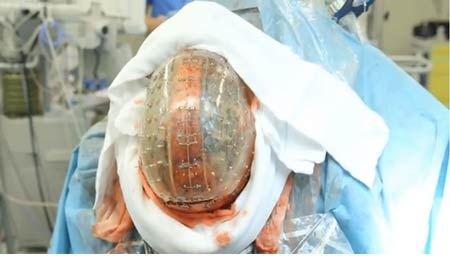 Những bước đột phá trong y học năm 2014 - 2 Sử dụng
máy in 3D để thực hiện ca ghép xương sọ đầu tiên của thế giới