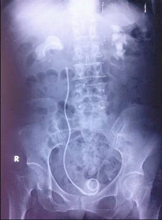 Ống thông JJ bỏ quên trong cơ thể người bệnh, bị gãy và bám
sỏi 2 đầu