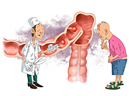“Khổ” như bị viêm đại tràng mạn tính - 1 Viêm đại tràng có thể làm cản trở khả năng hấp thu chất dinh
dưỡng và calo của cơ thể