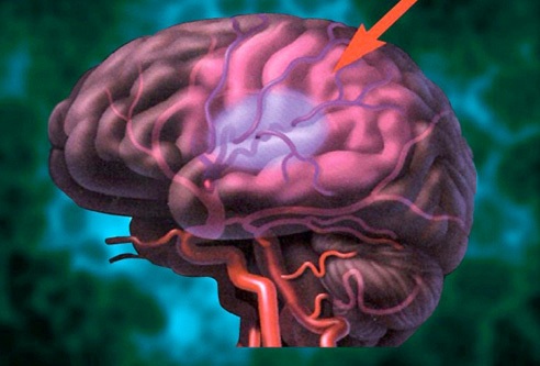 2 nguyên nhân chính