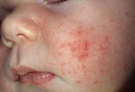 Phát hiện và chăm sóc một số bệnh ngoài da thường gặp ở trẻ - 2 Rôm sẩy
