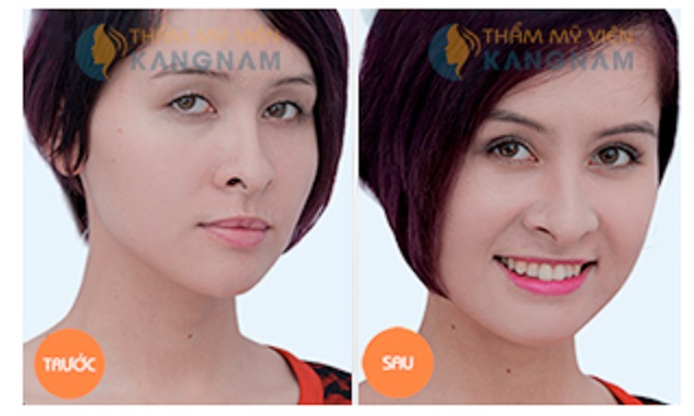 Ý kiến chuyên gia về các cách tạo mắt hai mí - 4 Bấm mí Dove Eyes không chỉ hiệu quả
mà còn an toàn cho người sử dụng