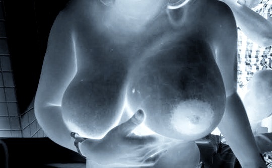 Một phụ nữ nhập viện do thời trẻ bơm ngực - 1 Một phụ nữ nhập viện do thời trẻ bơm ngực