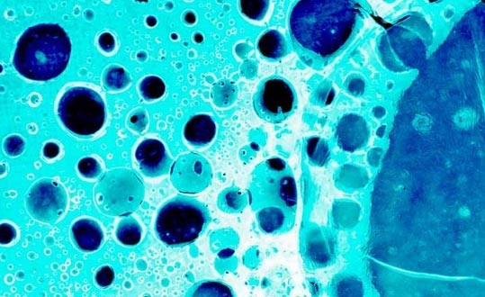 Mũi điện tử “ngửi” thấy nguy cơ ung thư dạ dày - 1 Tế bào ung thư dạ dày