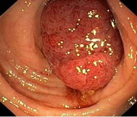 Hình ảnh ung thư đại tràng.