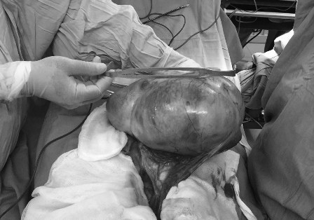 Bóc thành công khối u buồng trứng nặng 3,5kg cho trẻ 13 tuổi - 1 Khối u nặng 3,5kg chiếm hết ổ bụng bé gái 13 tuổi