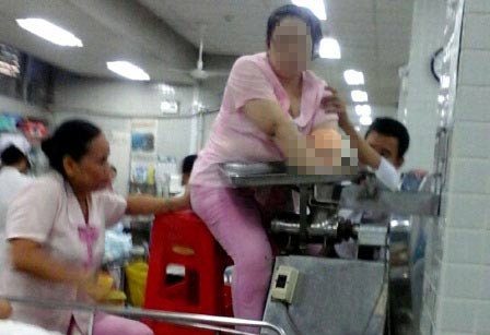 Chở cả máy xay thịt “nuốt chửng” bàn tay nạn nhân đi cấp cứu - 1 Chị L. vẫn trong tư thế ngồi xay thịt tại khoa cấp cứu