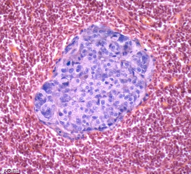 Hút thuốc lá liên quan tới 26 căn bệnh ở người - 2 Ung thư vú