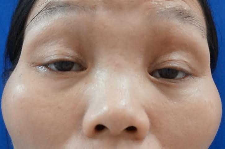 Thời điểm sau mổ