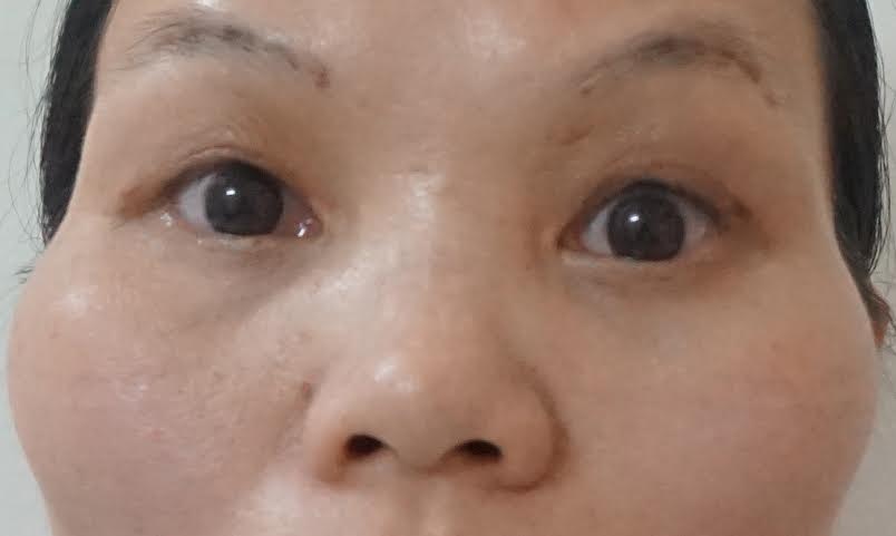 Thời điểm sau mổ