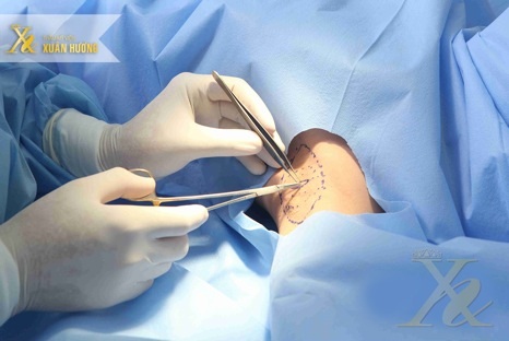 Xóa tan nỗi lo mồ hôi nách với công nghệ hút tuyến mồ hôi
nách nội soi