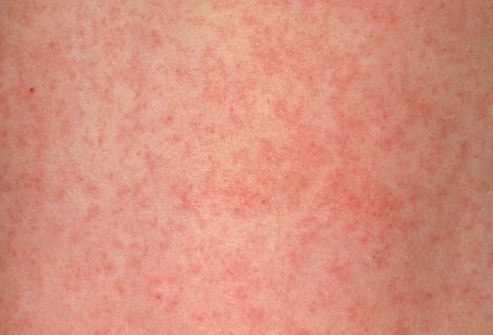 21 bệnh trẻ em mà các bậc cha mẹ nên biết - 13 Rubella