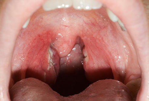 21 bệnh trẻ em mà các bậc cha mẹ nên biết - 16 Viêm họng liên cầu