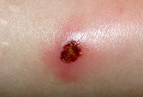 21 bệnh trẻ em mà các bậc cha mẹ nên biết - 18 Nhiễm tụ cầu/MRSA