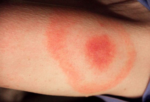 21 bệnh trẻ em mà các bậc cha mẹ nên biết - 20 Bệnh Lyme