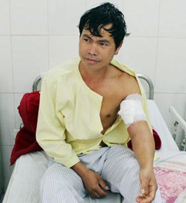 Phẫu thuật nối mạch máu ngoại vi cánh tay do khỉ cắn - 1 Lào Cai: Phẫu thuật thành công vết thương đặc biệt do khỉ cắn tay bệnh nhân