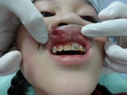 Trẻ 11 tuổi bị rách môi vì mắc cài chỉnh nha đâm vào - 1 Bệnh nhi bị tổn thương môi khá nặng do mắc cài chỉnh nha đâm vào