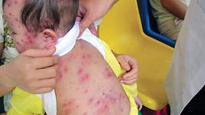 Chưa xuất hiện bệnh nhi sởi, rubella; lác đác ca thuỷ đậu - 1 Không
chủ quan!