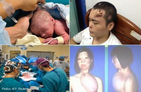 Những ca ghép bộ phận cơ thể hy hữu trên thế giới - 1 1. Ghép dương vật