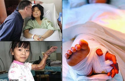 Những ca ghép bộ phận cơ thể hy hữu trên thế giới - 2 4. Thay thế nhiều bộ phận cơ thể