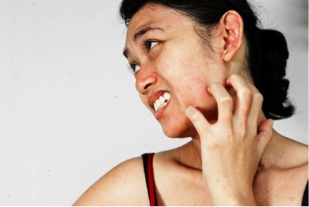 Dễ tái phát mề đay mẩn ngứa khi giao mùa - 1 Mề đay ảnh hưởng rất nhiều tới cuộc sống sinh hoạt hàng ngày