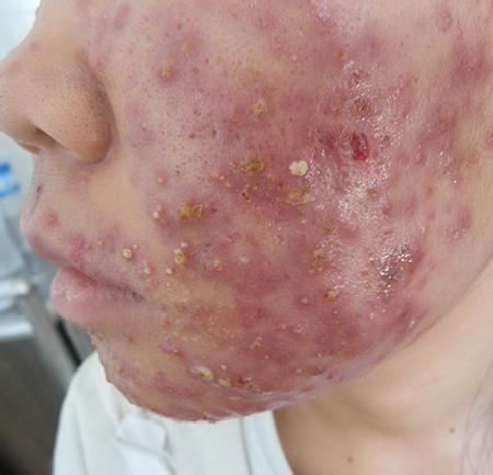 Hãi hùng “tiên dược làm đẹp” siêu rẻ và những hệ lụy khôn lường - 1 Hậu quả khi sử dụng sản phẩm làm đẹp không rõ nguồn gốc.