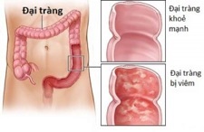Không điều trị sớm bệnh đại tràng - Nguy hiểm khôn lường! - 1 So sánh đại tràng của người bệnh
đại tràng và người bình thường.