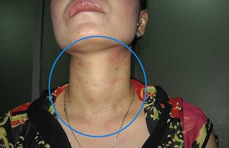 Xài dầu gội, tóc còn loe hoe! - 1 Một bệnh nhân sau khi sử dụng mỹ phẩm
đã phải đến BV Da liễu vì những vết nổi mẩn trên cổ. Ảnh: BS