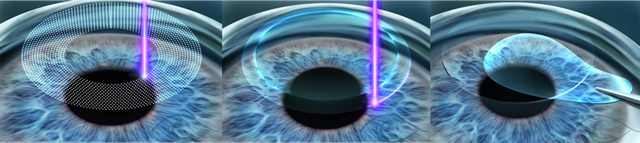 Điều trị cận thị: SMILE hay Lasik? - 2 Phẫu thuật SMILE