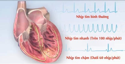 Những điều cần biết khi bị rối loạn nhịp tim - 1 Rối loạn nhịp tim bao gồm nhịp tim nhanh, chậm, không đều