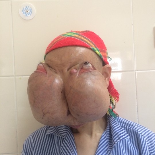 Patient Ly Mui Xien has a giant tumor being cared for at Central K Hospital