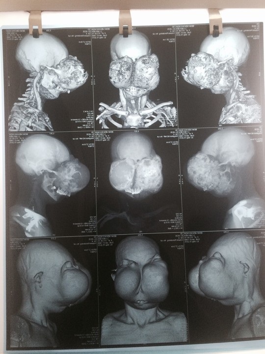 Computed tomography image of the patient's giant tumor