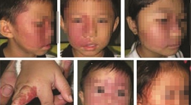 U máu có nguy hiểm đến tính mạng? - 1 Trẻ bị u máu điều trị tại Trung tâm U máu Đại học Y Dược
TPHCM