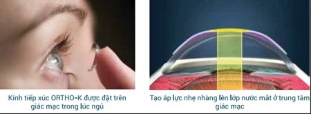 Có thể điều trị cận thị bằng Ortho- K không? - 1 Cơ chế tác động của Ortho-K
lên mắt