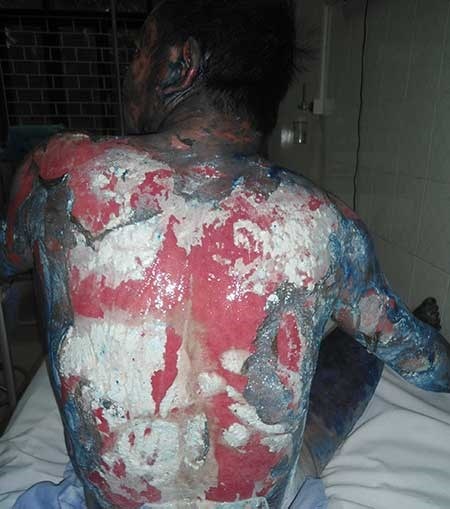 Bệnh nhân bị
trợt da toàn thân do ngộ độc thuốc Đông y. Ảnh: DL