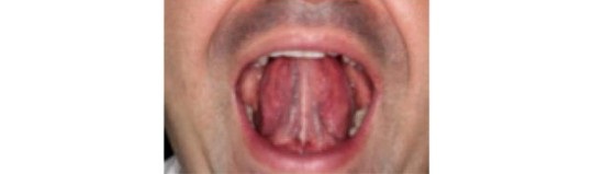6 bài tập miệng giúp giảm chứng ngủ ngáy - 2 2. Hút lưỡi lên phía trên vòm miệng 20 lần.