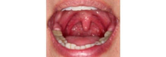 6 bài tập miệng giúp giảm chứng ngủ ngáy - 4 4. Nâng ngạc mềm và lưỡi gà lên 20 lần.