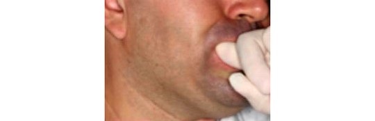 6 bài tập miệng giúp giảm chứng ngủ ngáy - 6 5. Dùng ngón trỏ đẩy vào cơ vùng má ra ngoài 10 lần mỗi bên.