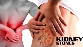 Những biến chứng không ngờ từ sỏi thận - 1 Sỏi thận gây những đau buốt.