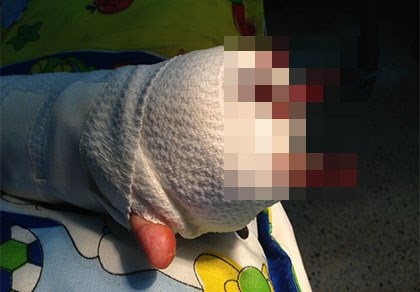 Bé trai đứt bốn ngón tay do chơi xe đạp điện - 1 Bé trai đứt bốn ngón tay do chơi xe đạp điện