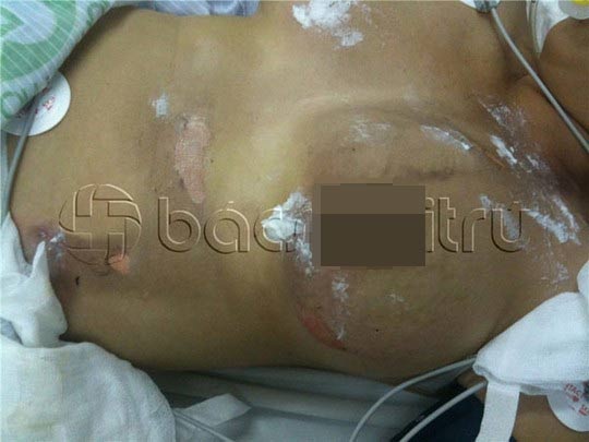 Nhiều tổn thương trên ngực thai phụ do sét đánh - Ảnh do bác
sĩ cung cấp