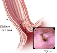 Bệnh trào ngược dạ dày thực quản nguy hiểm hơn bạn biết - 1 10% có
hiện tượng khó nuốt