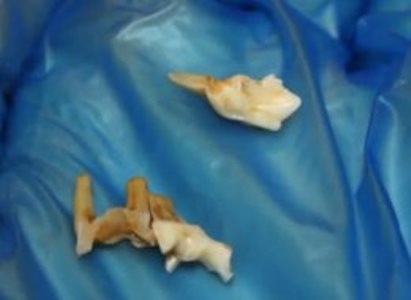 Vớ phải răng người khi đang ăn đậu phộng - 1 Chiếc răng bí ẩn