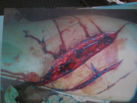 Một phụ nữ bị vợ chủ tịch xã đánh đập dã man