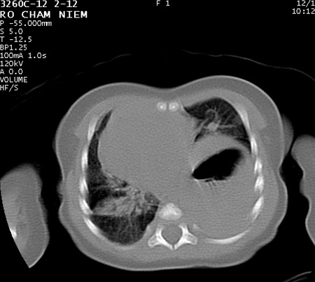 Cứu sống trẻ sơ sinh thoát vị hoành - 2 Hình ảnh chụp phim của bé Nêm